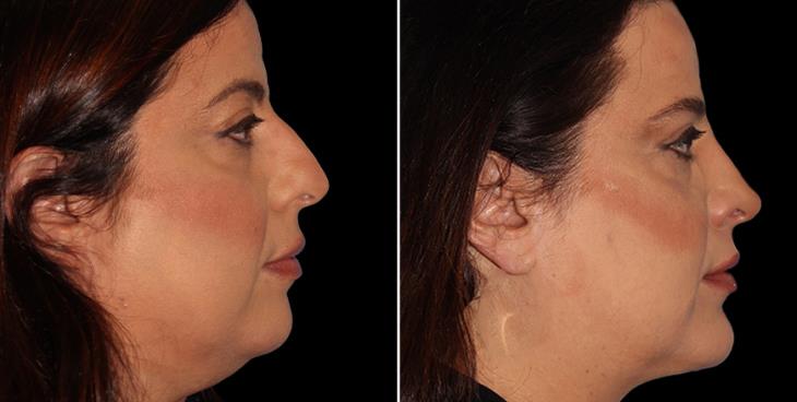 Atlanta GA Scarless Nose Surgery Results Side View